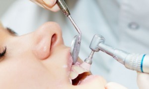 hygiène et prévention dentaire, détartrage