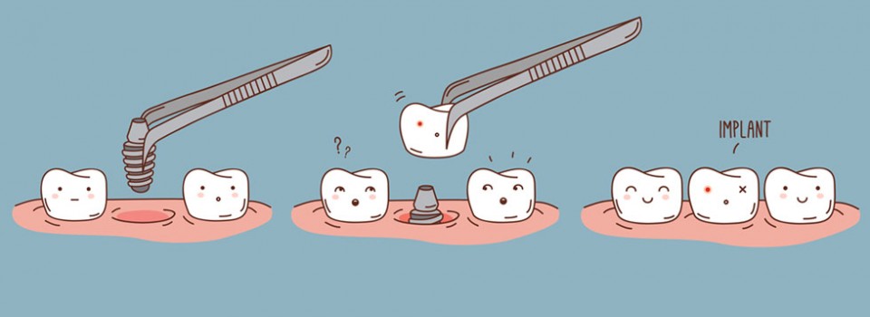 implants-dentaires-implantologie